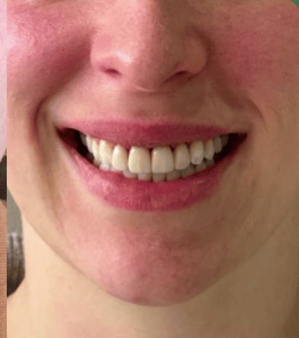 Smile Design & Veneers after treatment