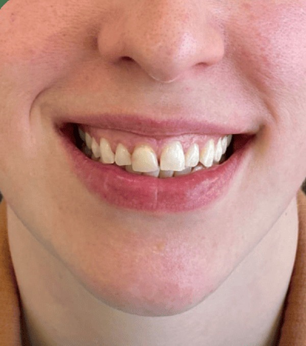 Smile Design & Veneers before treatment